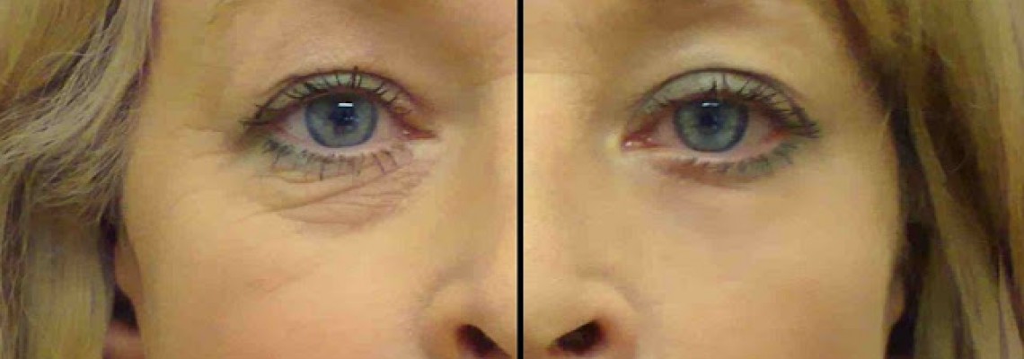 Това Най-Мощно Лекарство Срещу Бръчките Около Очите Има Само 2 Съставки !