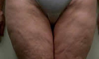 Модерни Средства за Бързо Отслабване